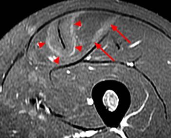 (adduction is the action of pulling in . MRI of Rectus Femoris / Quadriceps Injury - Radsource