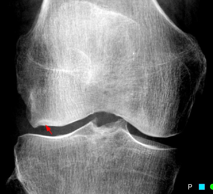 Sitz der gesellschaft ist der ort im inland, den der gesellschaftsvertrag bestimmt. Subchondral Fractures - Radsource