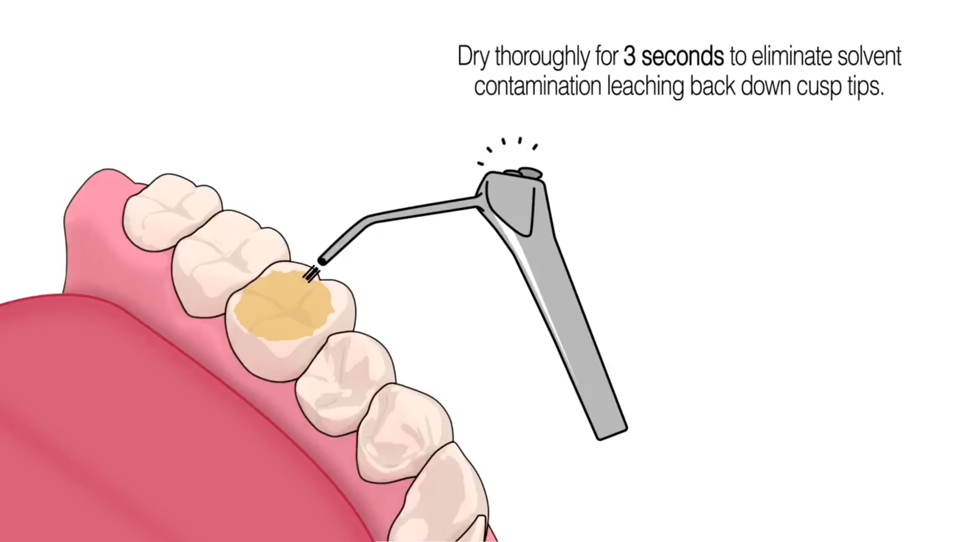 Bonding Posterior Occlusal Build-Up & Anterior Lingual Bite openings