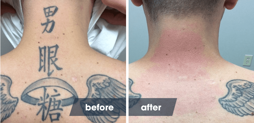 The Laser Tattoo Removal Healing Process | Removery 400_x_826_png
