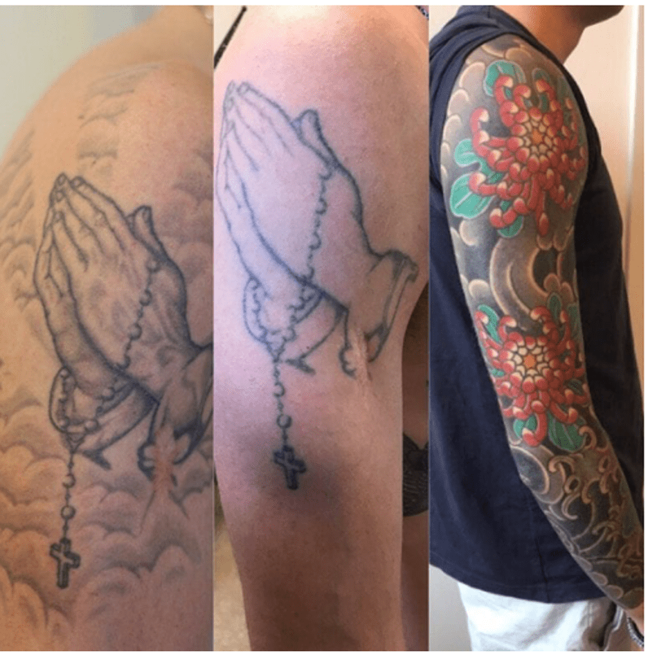 Confidence, community, and joy in this article a tattoo is the very definition of body art. What To Know About Tattoo Lightening Removery