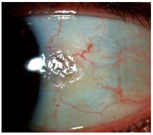 Here are some of the best models to choose from. Lesson: The Role of UV Damage in Ocular DiseaseMany