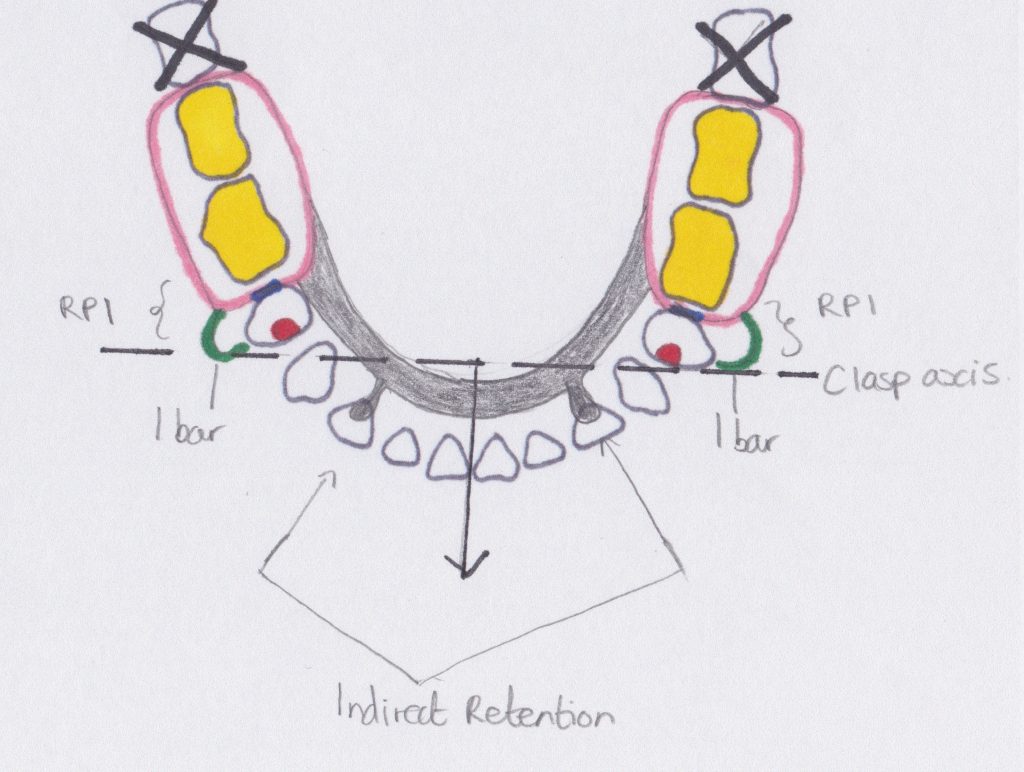 Of an extensive mandibular bilateral distal extension saddle denture. Rpd Design Revise Dental