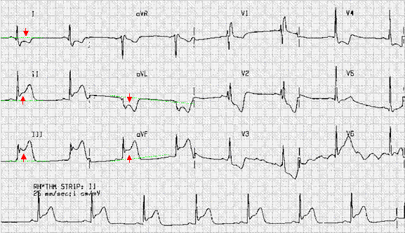 Penyakit jantung koroner, gambran klinis, . Belajar Ekg Neurotouch