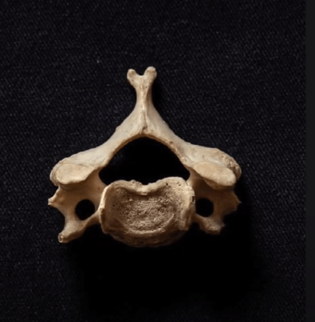 Here there is a form to fill. Cauda Equina Syndrome* (CES) - McMahon Goldrick Solicitors