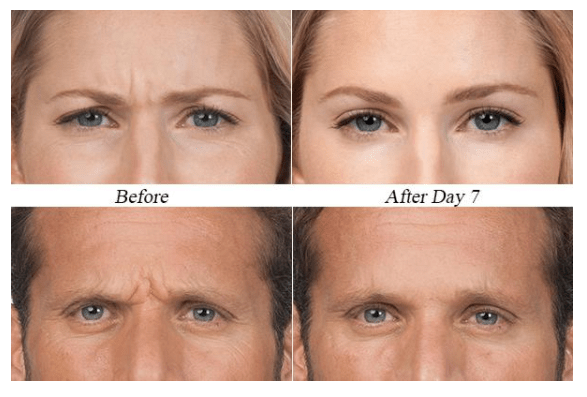 Dentist Appointment After Botox  . By Far, These Are The Two Fastest Growing Cosmetic Treatments I Have Found Now, After Speaking To Thousands Of Dentists Through My Lectures About These Procedures, That We As A Dental Industry Are Pretty Much Ignorant Of.