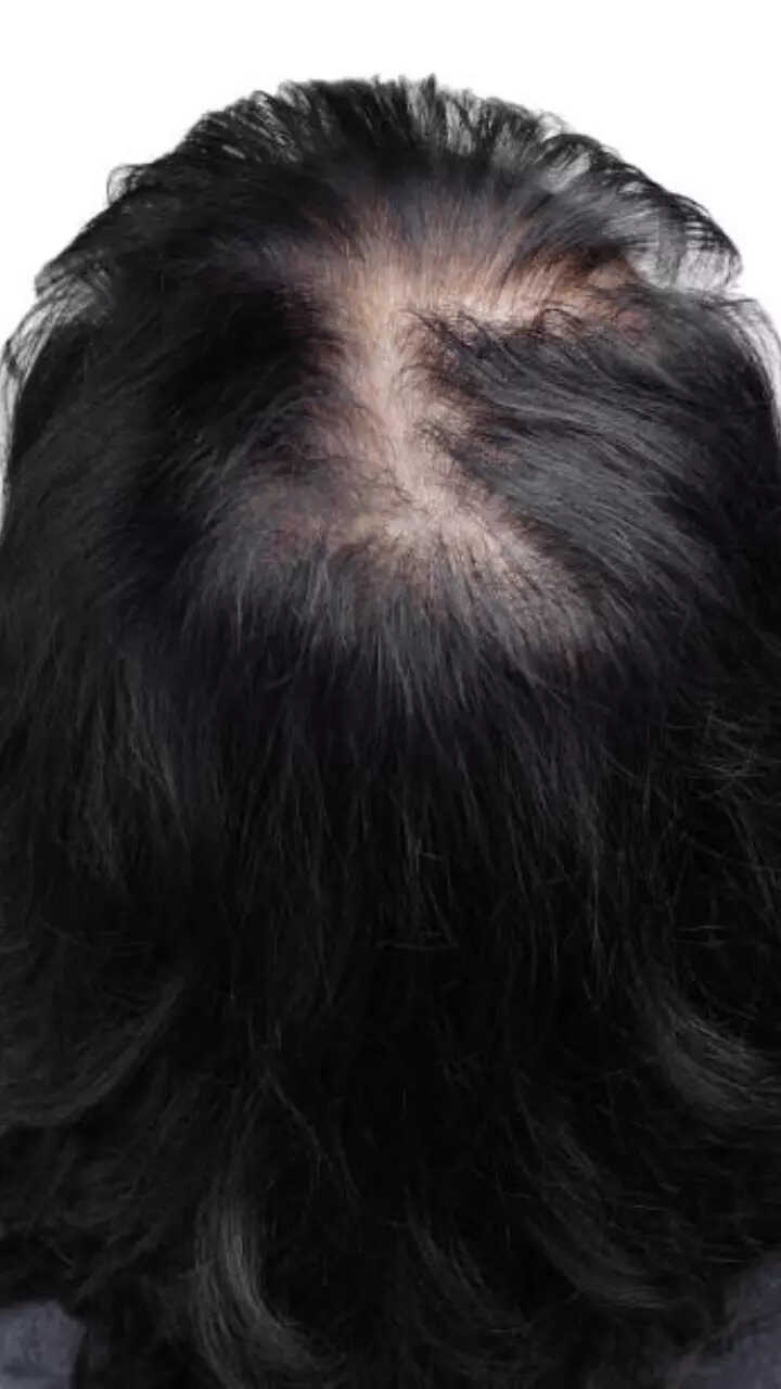 How you can grow hair on bald patches at home How you can grow hair on bald patches at home