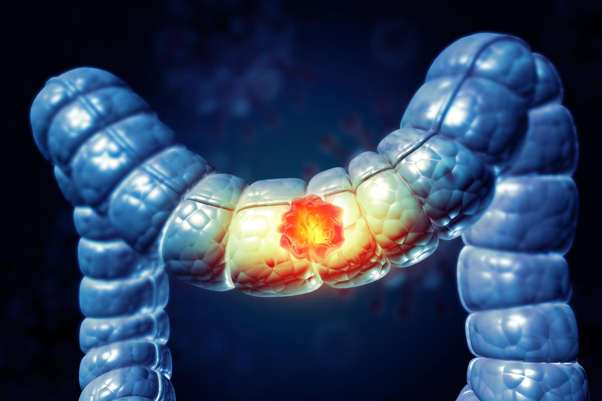 Breakthrough Discovery: Researchers Unravel 15-Year Mystery of Cancer-Causing Gut Toxin