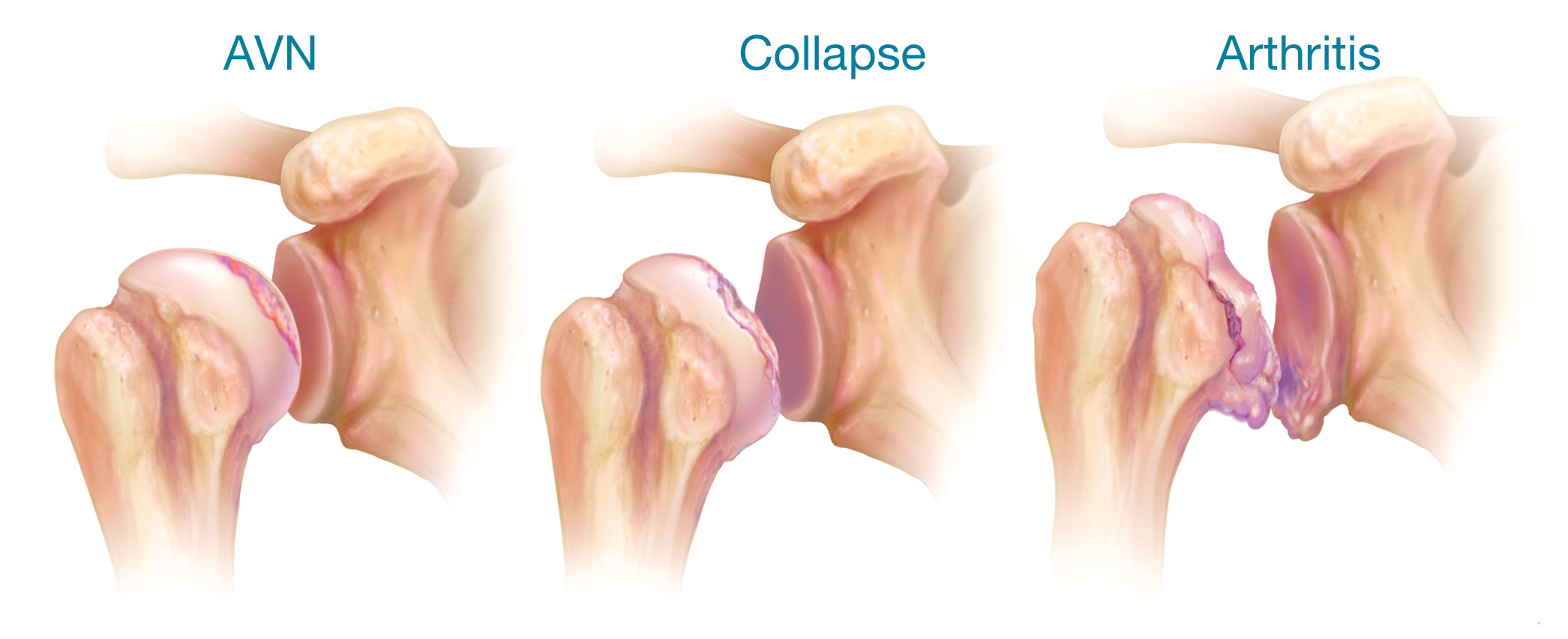Avascular Necrosis: When the Shoulder Humeral Head Suffers a Stroke ...