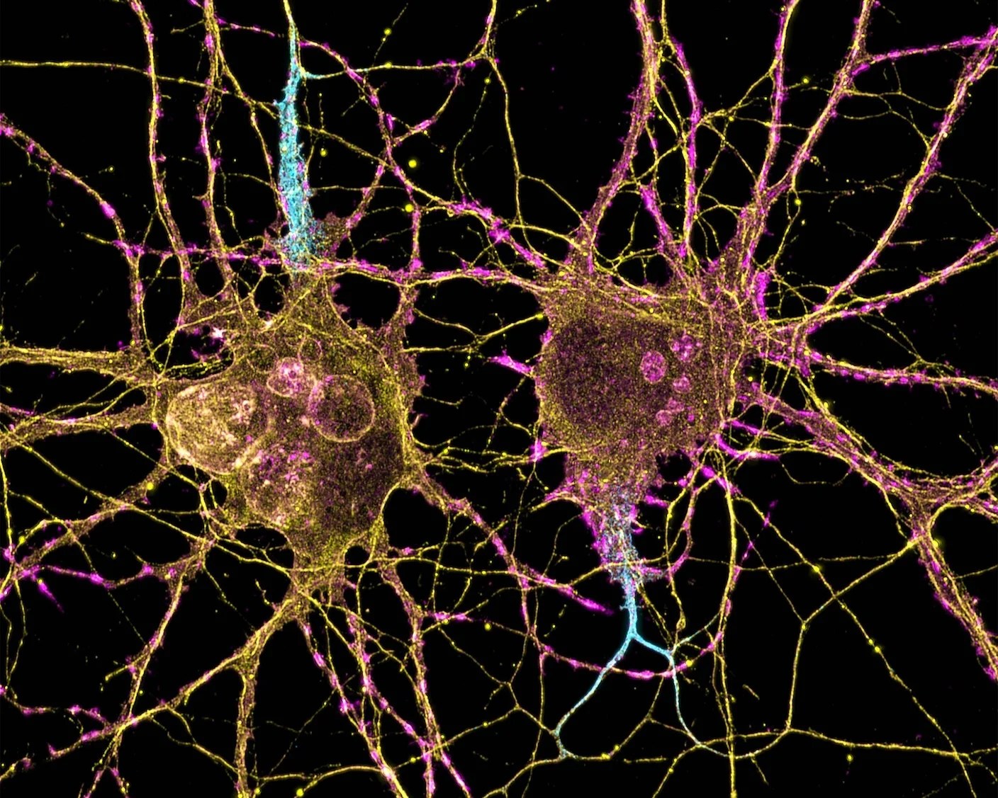 A New Approach Could Transform Huntington’s Disease Treatment A New Approach Could Transform Huntington’s Disease Treatment