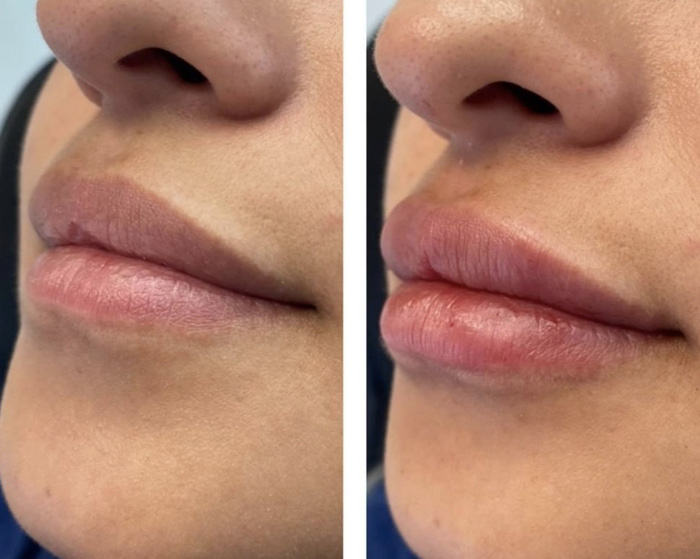 Discover injectable & filler deals in and near austin, tx and save up to 70% off. Lip Injection Syringe Skin Envy