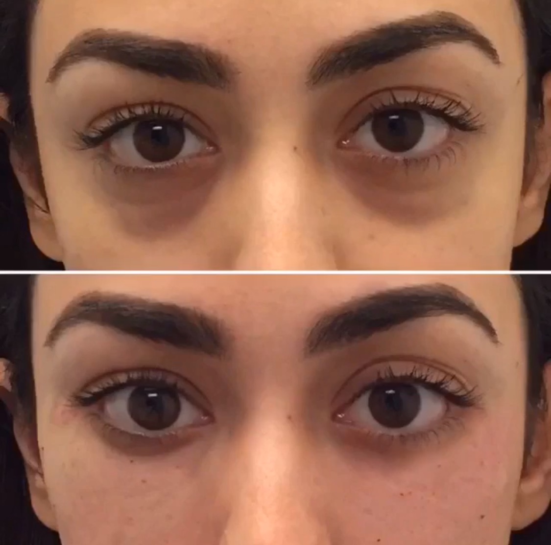 picture How To Get Rid Of Dark Under Eye Bags imt mines albi
