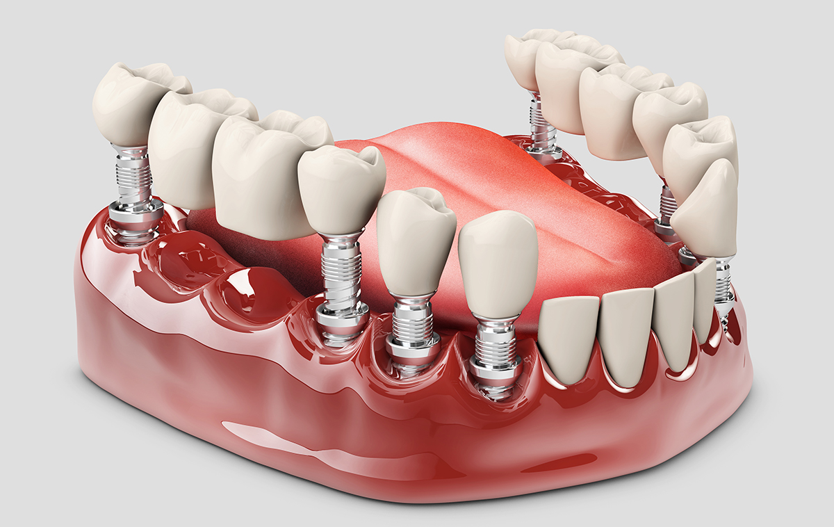 Permanent Dentures Cost 2019  : Affordable Dentures Are Offered In A Variety Of Denture Styles That Include Full And Partial Dentures.