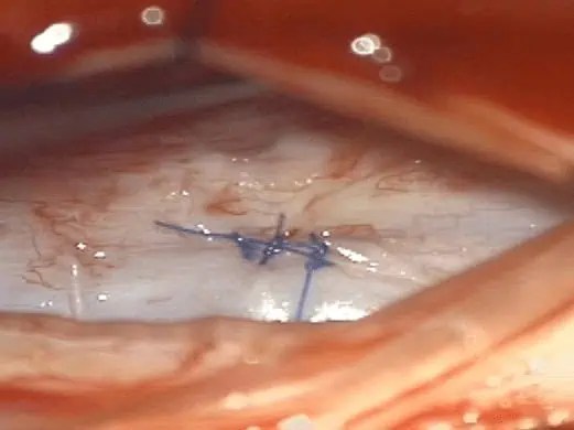 5657 wilshire blvd, ste 250, los angeles, ca “ asaf and mariana kept us informed on progress on a regular basis and responded quickly to any questions we had. Treatment | Spinal CSF Leak Foundation