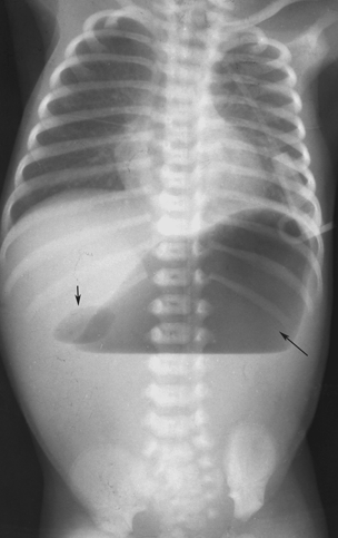 1) target sign, 2) crescent sign, … Pediatrics Chapter 8 Emergency Radiology