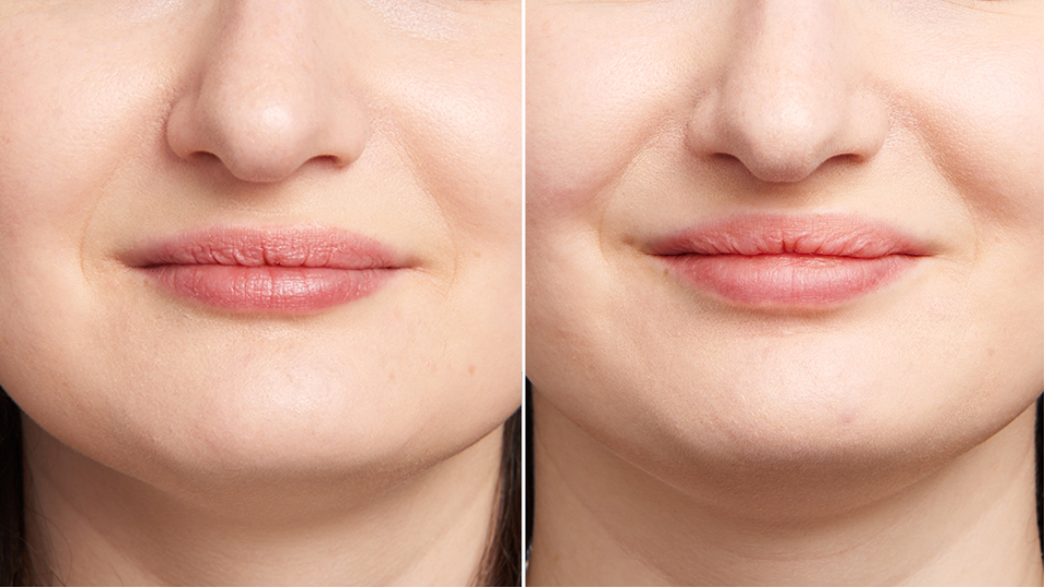 It can take 2 weeks for the product to soften and settle; I Love My Lip Injections Even Though I Didn T Really Need Them Stylecaster