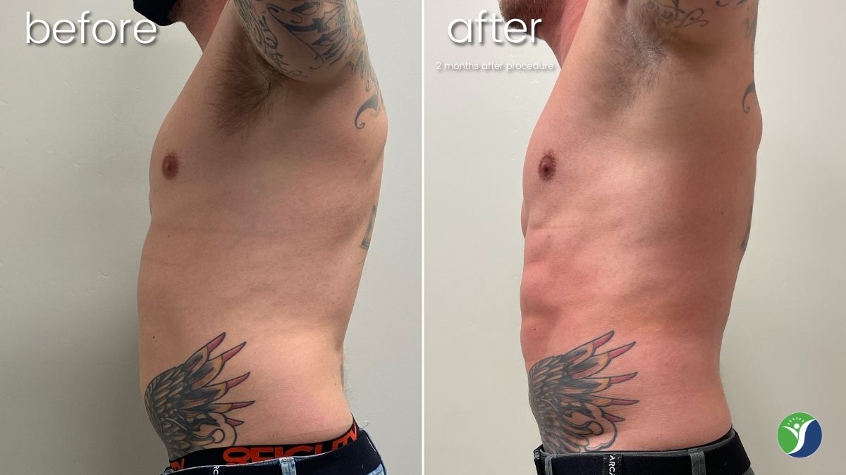 Gynecomastia Treatment Bakersfield | Male Breast Reduction 675_x_1200_jpg