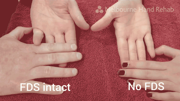 The general cause of the phenomenon is a disruption in the normal communication. Fun Facts About Your Hands Tanya Coats Occupational Therapy