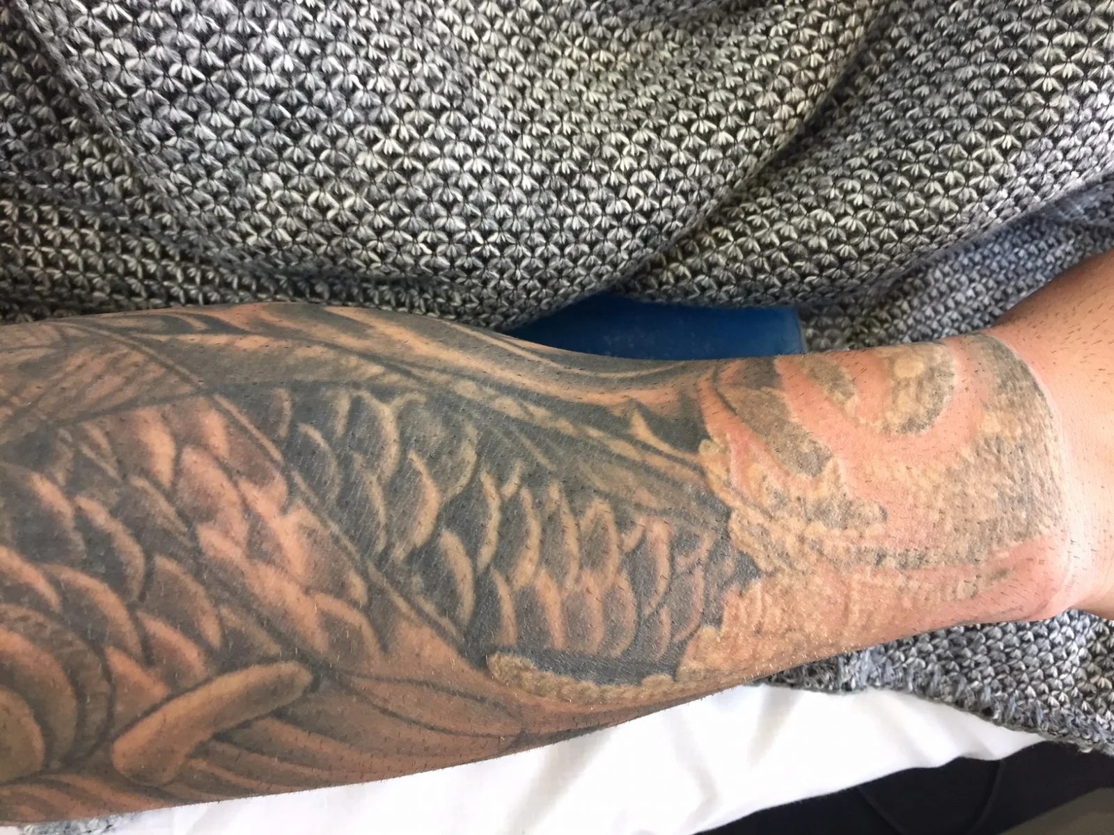 Can Laser Tattoo Removal Make You Sick? | Deink Tattoo Removal 1200_x_1600_jpg