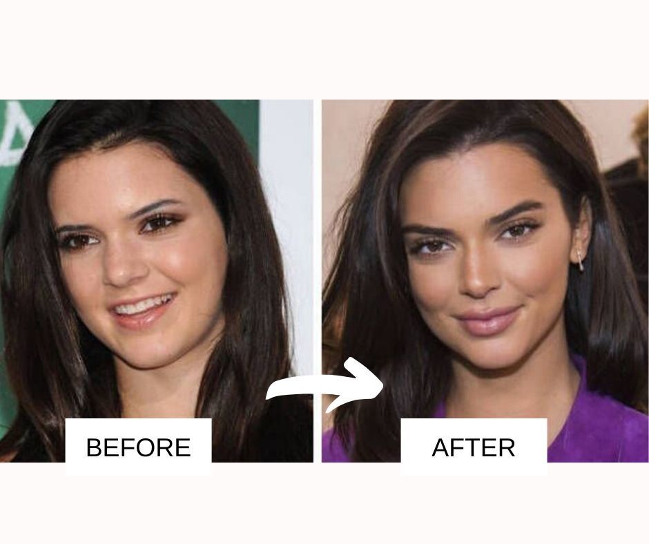 Too faced lip injection extreme · 4. 25 Most Popular Celebrities With Lip Fillers Before And After With Images
