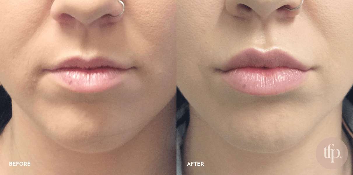 What do lip fillers look like before and after? Gallery That Face Place