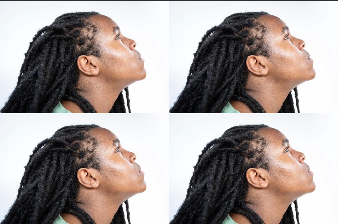A concussion and a lacking dreadlock