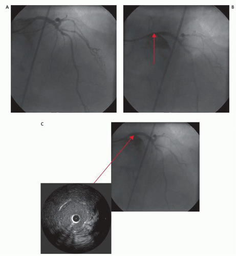 Left Mainstem Intervention | Thoracic Key