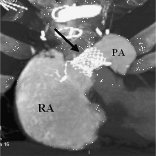 Thoracic Vascular Anomalies | Thoracic Key