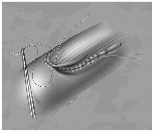 Transhiatal Esophagectomy | Thoracic Key