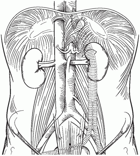 Redo Aortobifemoral and Thoracobifemoral Bypass for Aortoiliac ...