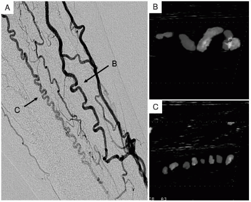 Buerger’s Disease (Thromboangiitis Obliterans) | Thoracic Key
