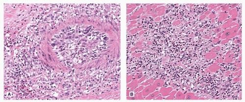 Cardiac Involvement in Rheumatologic Diseases | Thoracic Key