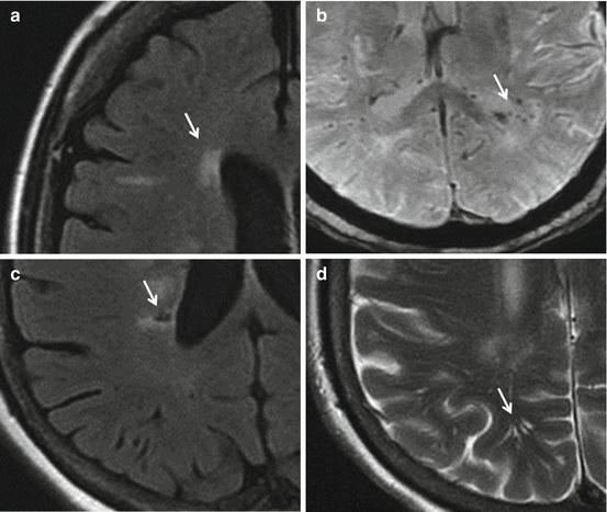 MRI/CT: Evaluation of Brain Damage in Hypertension | Thoracic Key