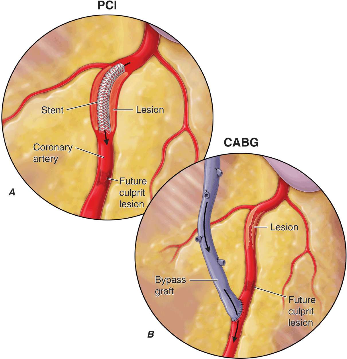 Ischemic Heart Disease Thoracic Key