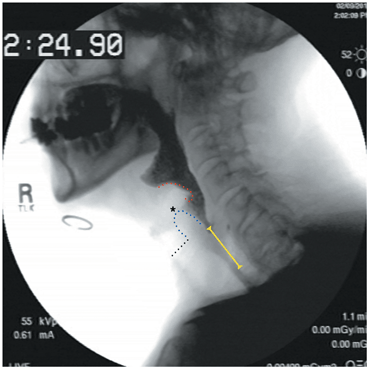 Normal Pharyngoesophageal Segment Fluoroscopy | Thoracic Key