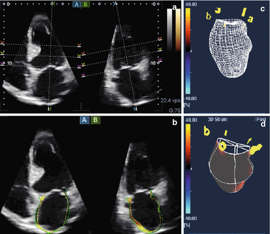 3D-Wall Motion Tracking: Measuring Myocardial Strain with 3D | Thoracic Key