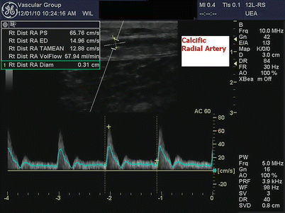 Duplex Ultrasound Imaging of the Radial Artery | Thoracic Key