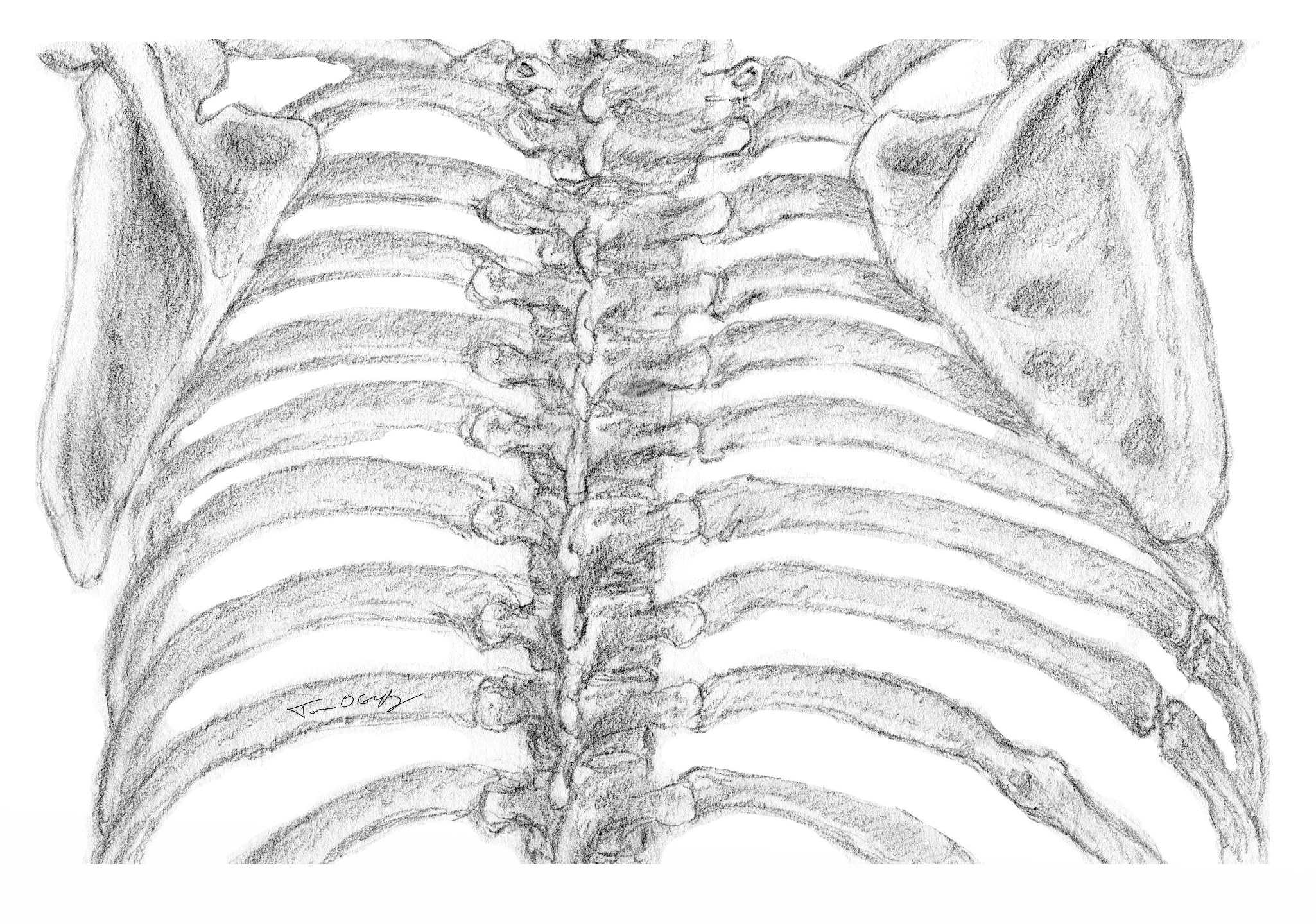 Fracture de côtes | thoracotomie