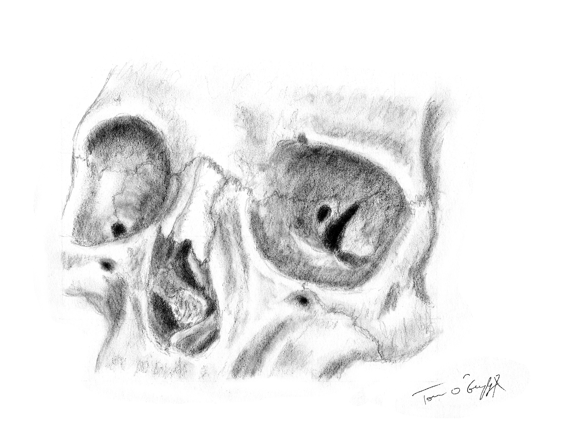 Fractures du massif facial : plancher de l’orbite et complexe  zygomatico-maxillo-malaire | thoracotomie