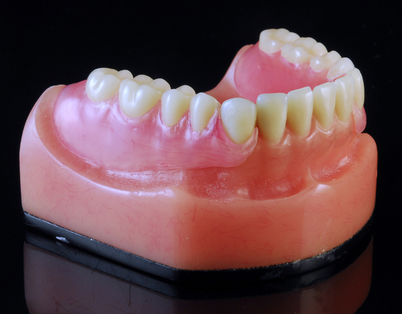 Valplast Denture Repair  - A Cast Thermo Plastic Denture That Is Thin, Lightweight, And Flexible With Invisible Clasps That Surround The Natural Teeth.