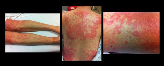 15.11.2021 · these side effects usually start within a day or two of getting the vaccine. UMEM Educational Pearls - University of Maryland School of