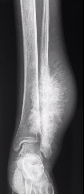 Osteosarcoma Knee - Osteosarcoma - Oncology - Medbullets Step 2/3