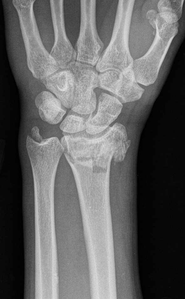 It is triangular in shape and made up of several ligaments and cartilage. Distal Radius Fractures - Trauma - Orthobullets