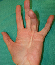 Dupuytren's disease (dd) is a progressive fibrosis of the palmar fascia characterized by the formation of a nodule, which evolves into a cord. Dupuytren S Disease Hand Orthobullets
