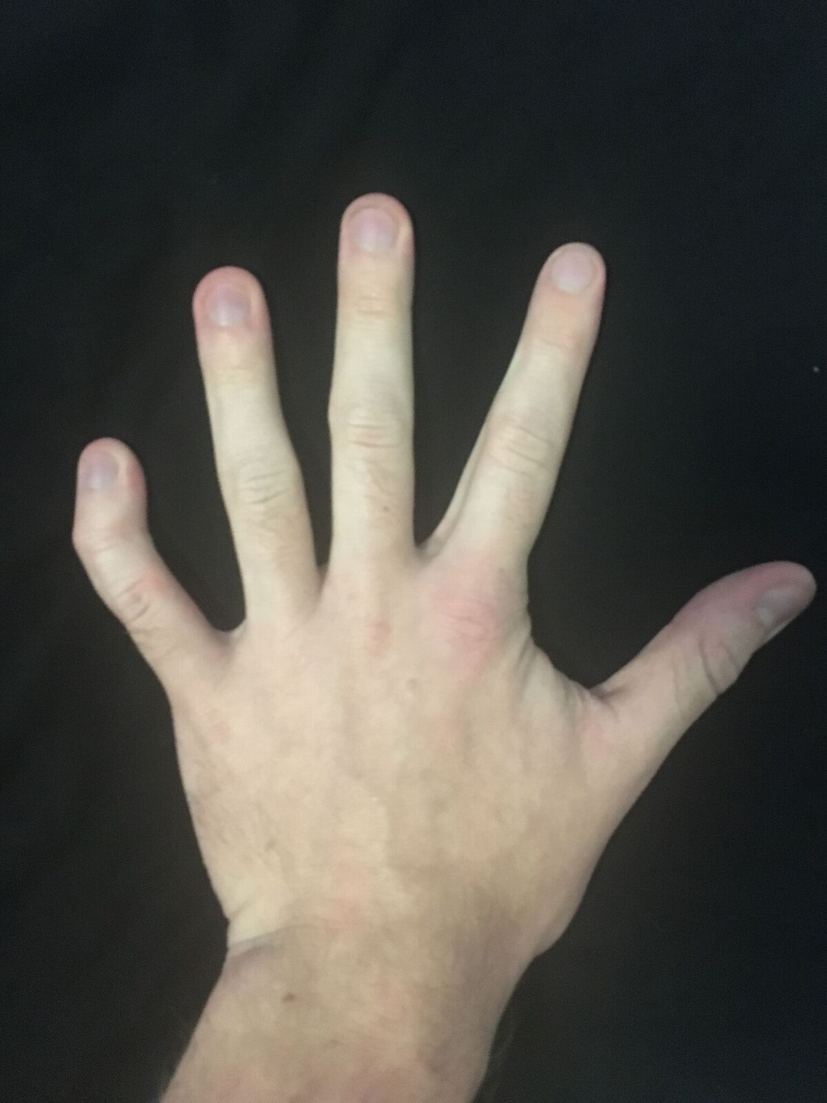 Heterozygous mutations in the kdm1a gene have been identified in two patients. Clinodactyly Wikipedia