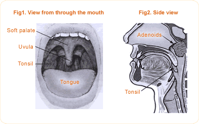 IF ADENOID = Bernafas Secara Mulut + Tidur Mengorok (Sleep Apnea) +  Penurunan Pendengaran THEN KONSULTASI KE DOKTER THT | blog tempat berbagi  ilmu dan pengetahuan