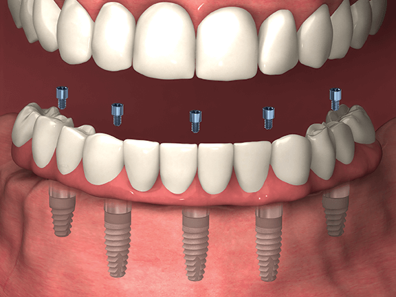 Dentures Attached To Implants  . The Pricing Is Terrific And Clear.