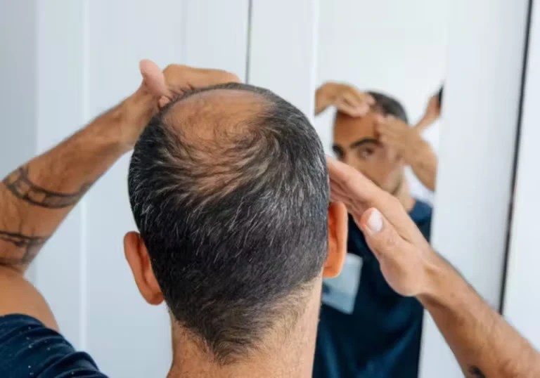 tratamento calvicie