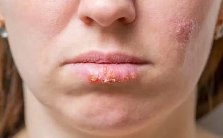 herpes