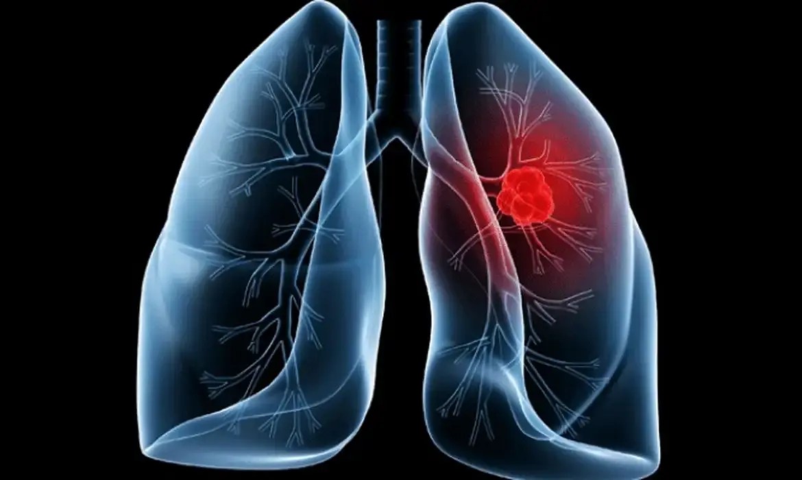 adenocarcinoma pulmonar